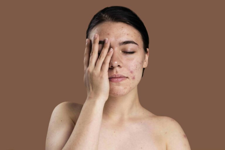 portrait young woman being confident with her acne min 1 1 768x513