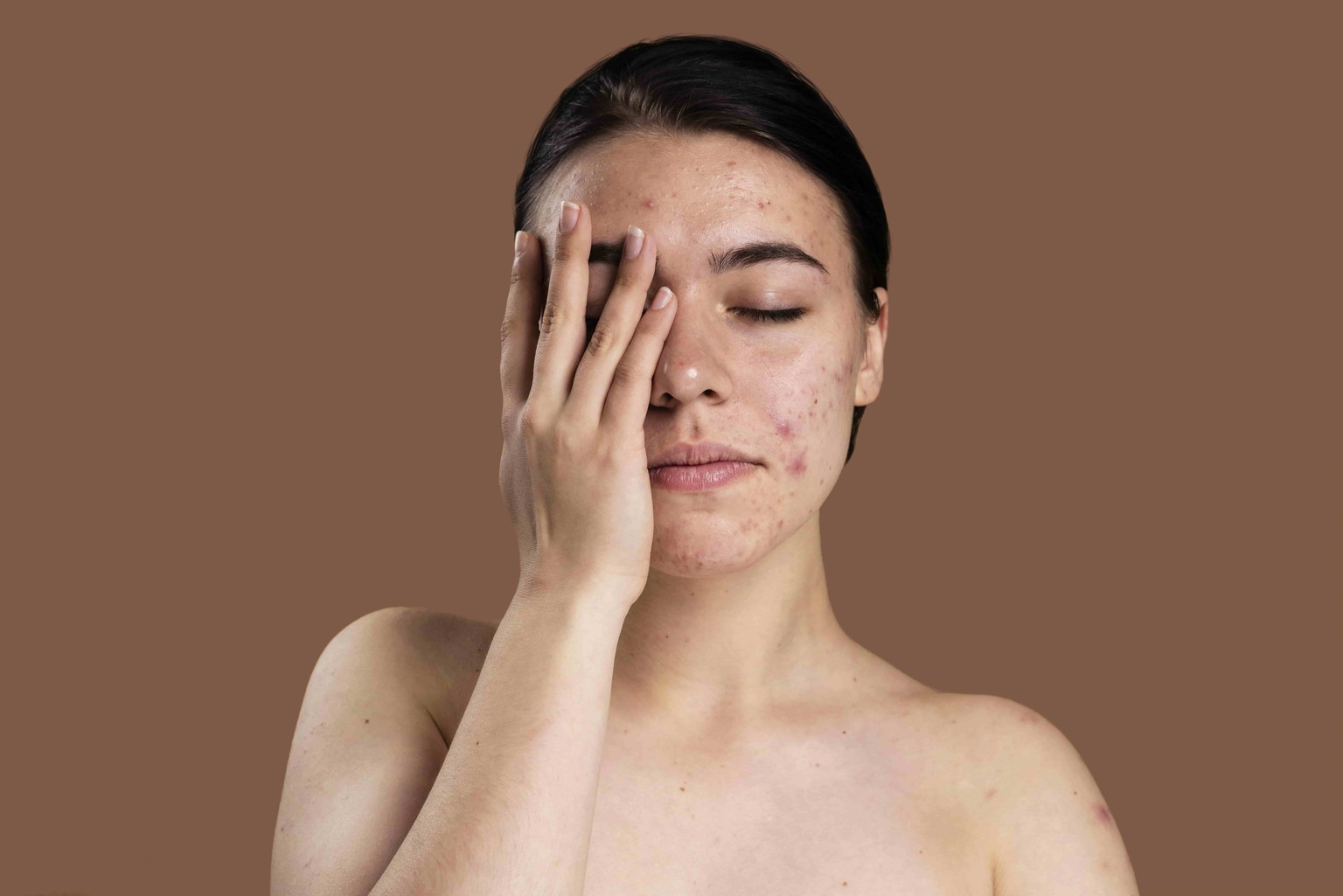 portrait young woman being confident with her acne min 1 1